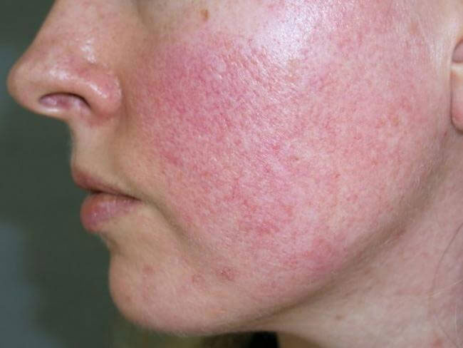 Da nhiễm corticoid do kem trộn