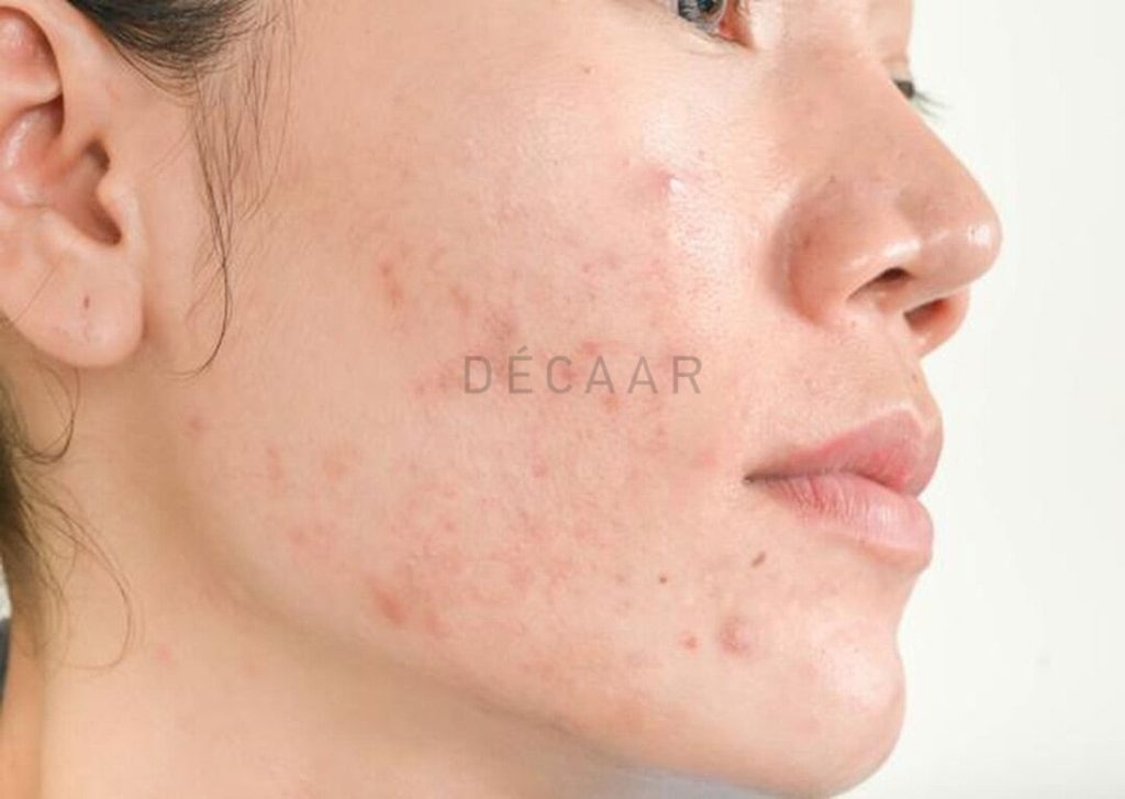 Mặt nạ giúp hỗ trợ điều trị mụn