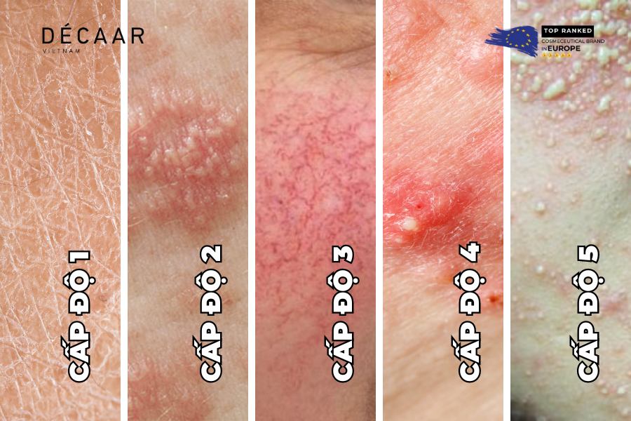 Ảnh các cấp độ của da nhiễm Corticoid