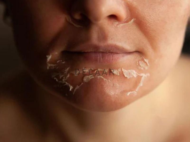 Ảnh Peel da sạm