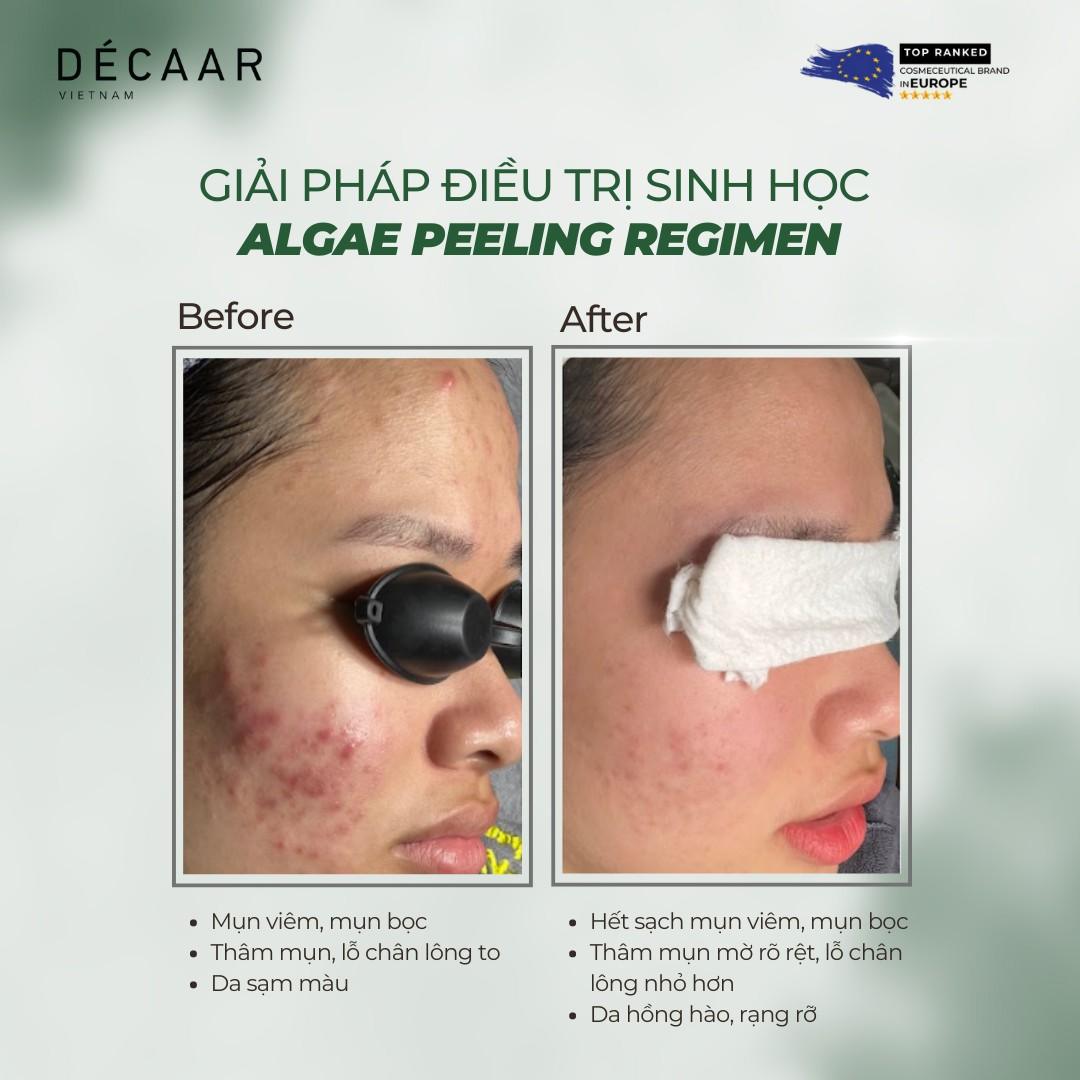 Before - After của liệu trình vi kim tảo biển trị mụn