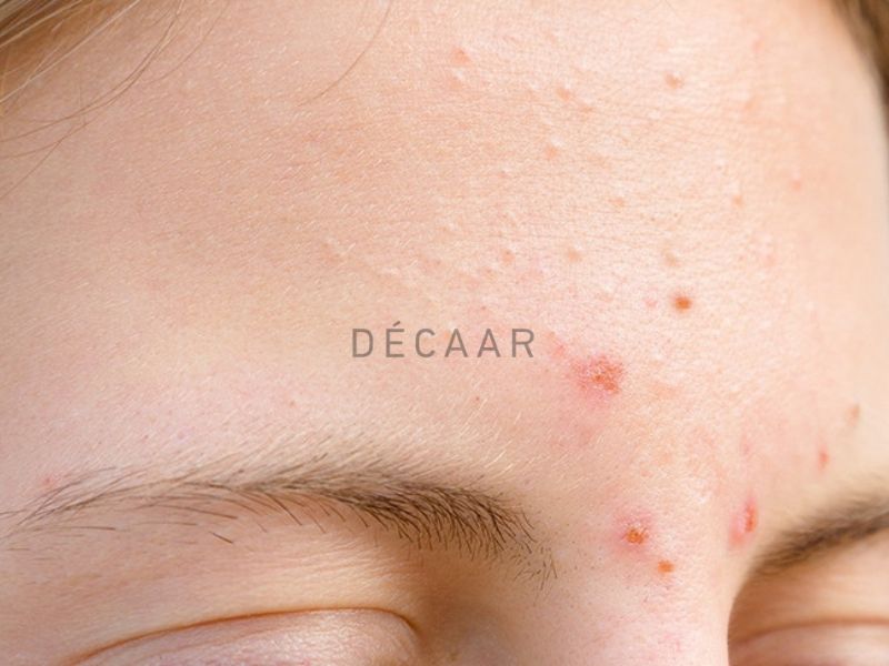 Mụn Trứng Cá Thông Thường