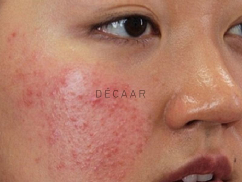 Mụn Corticoid