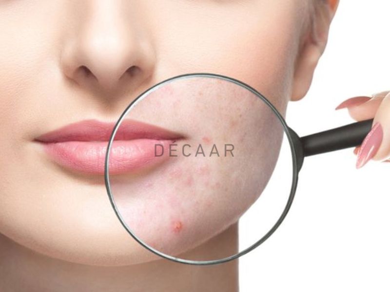 Phòng Ngừa mụn từ sớm là cách trị mụn từ xa