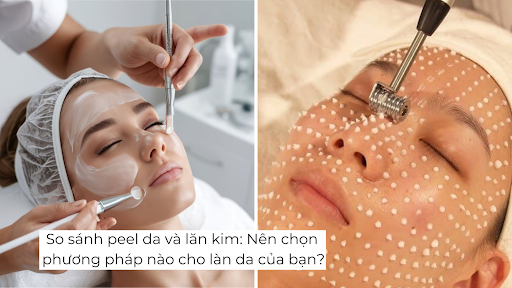So sánh peel da và lăn kim