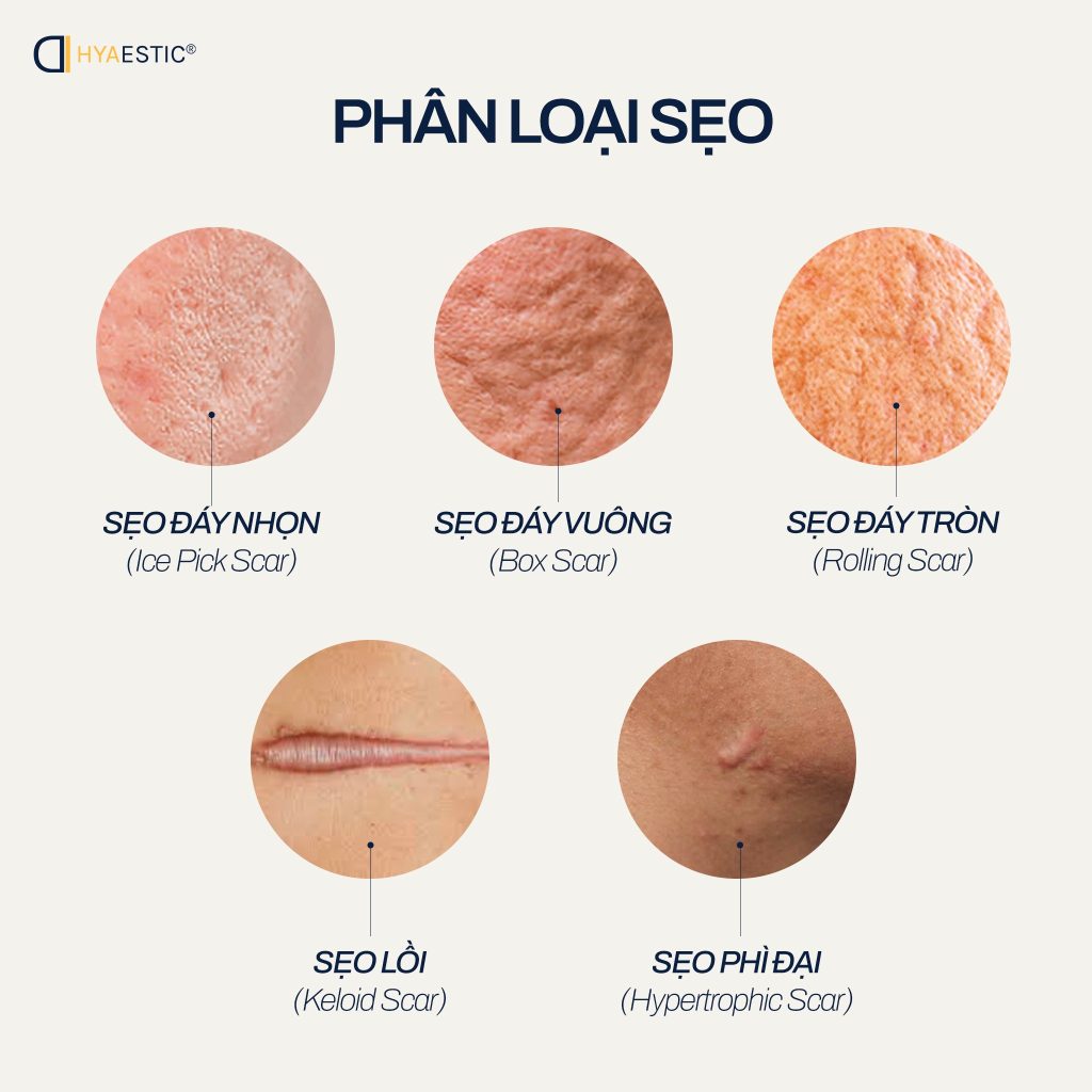 Phân loại sẹo