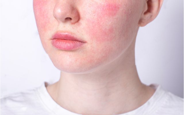 Lạm dụng acid khiến da mỏng yếu và nhạy cảm