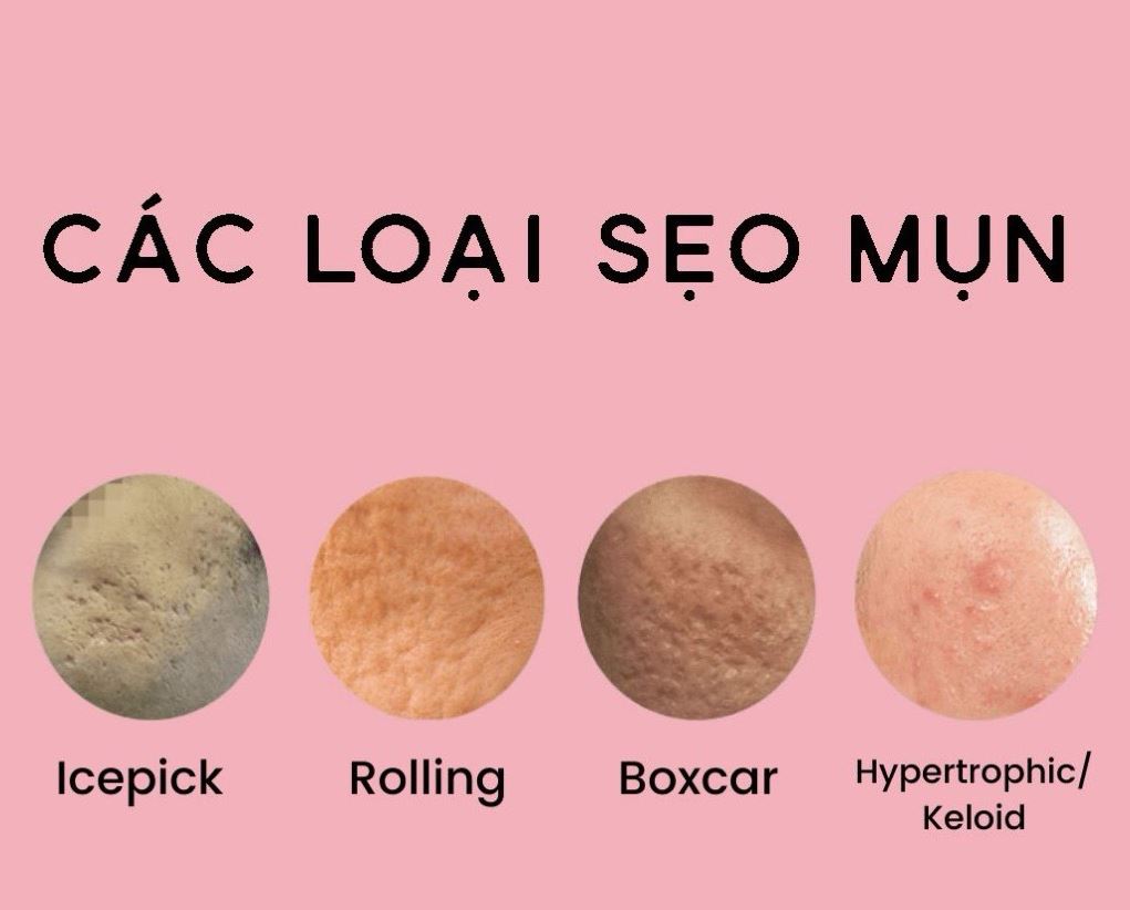 Hình: Các loại sẹo mụn