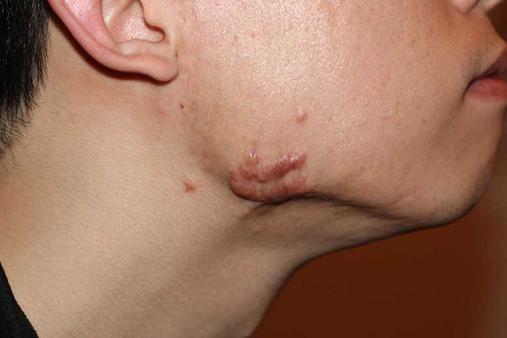 Hình: Sẹo lỗi sau mụn trứng cá