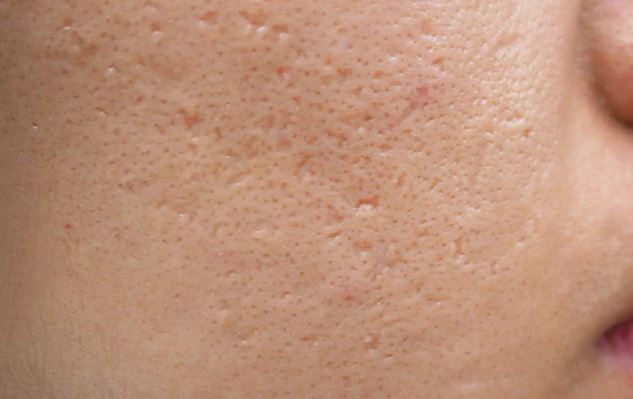 Hình: Sẹo rỗ đáy nhọn trên da