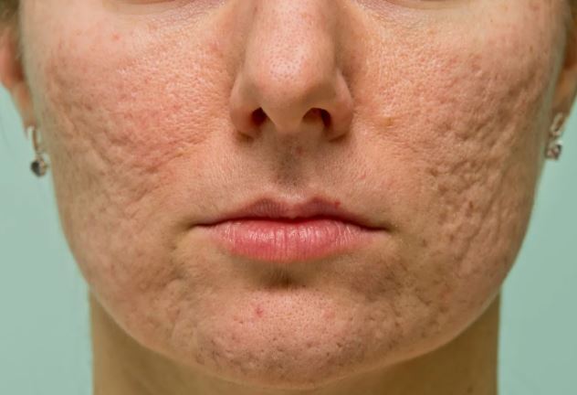 Hình: Sẹo rỗ gợn sóng trên da