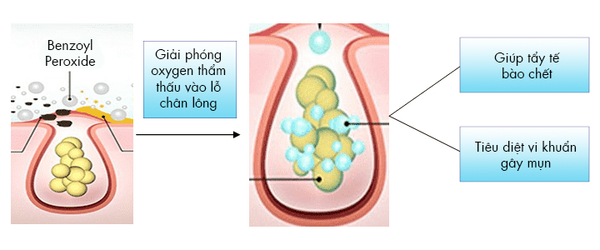 Hình: Mô tả cơ chế trị mụn của BPO