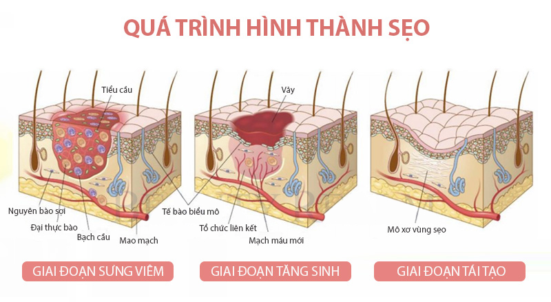Hình: Quá trình sẹo phát triển