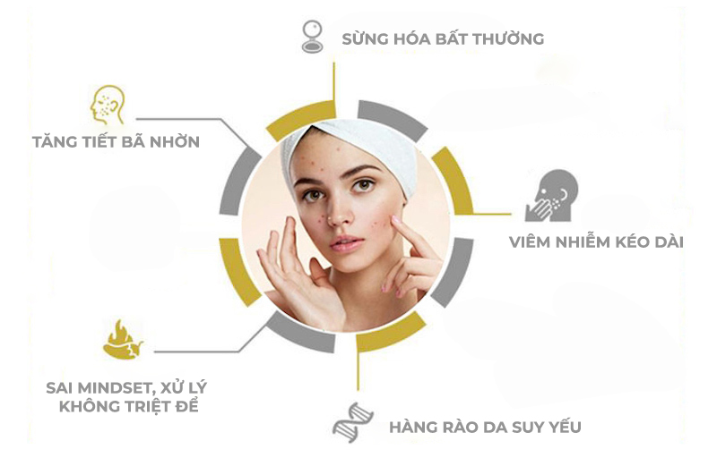 Hình: Nguyên nhân khiến mụn tái phát