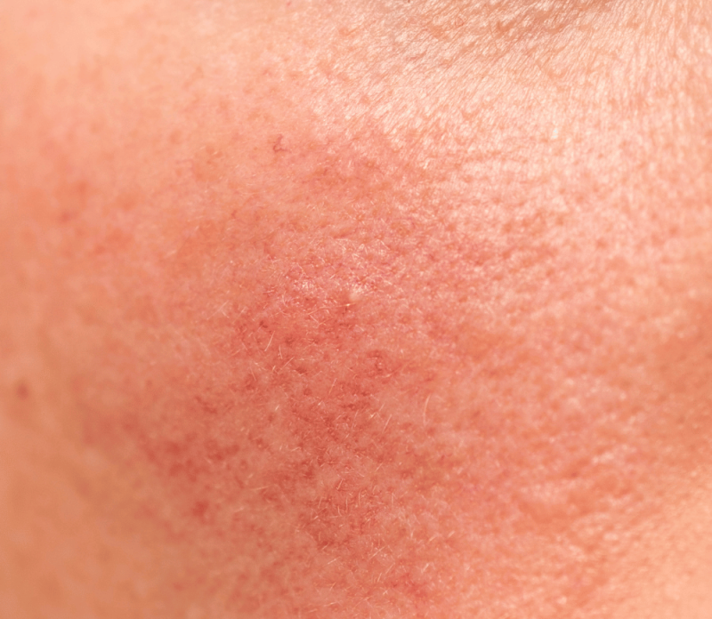 Hình: Hàng rào da bị đỏ khi tiếp xúc nắng liên tực hàng giờ liền