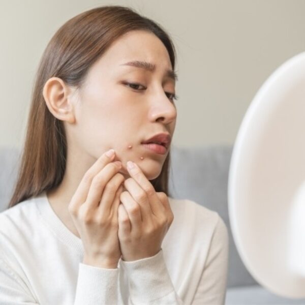 Hình: Mụn trở lại làm bạn băn khoăn