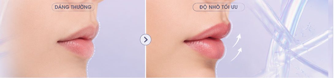 Hình|: Teoxane RHA giúp nâng đỡ hình dáng đôi môi