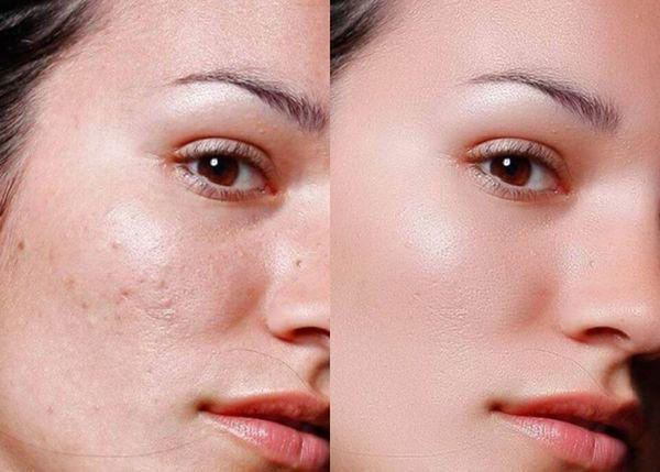 Hình: Loại bỏ sắc tố cũ & tái tạo bề mặt da