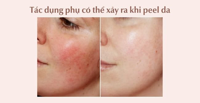 Tác dụng phụ khi Peel da